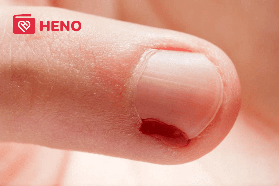 Đi làm móng bị chảy máu: Có nguy hiểm không? Cần xử lý như thế nào?